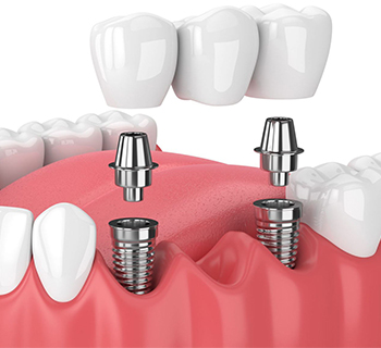 Best Dentist for Tooth Pain in Chembur